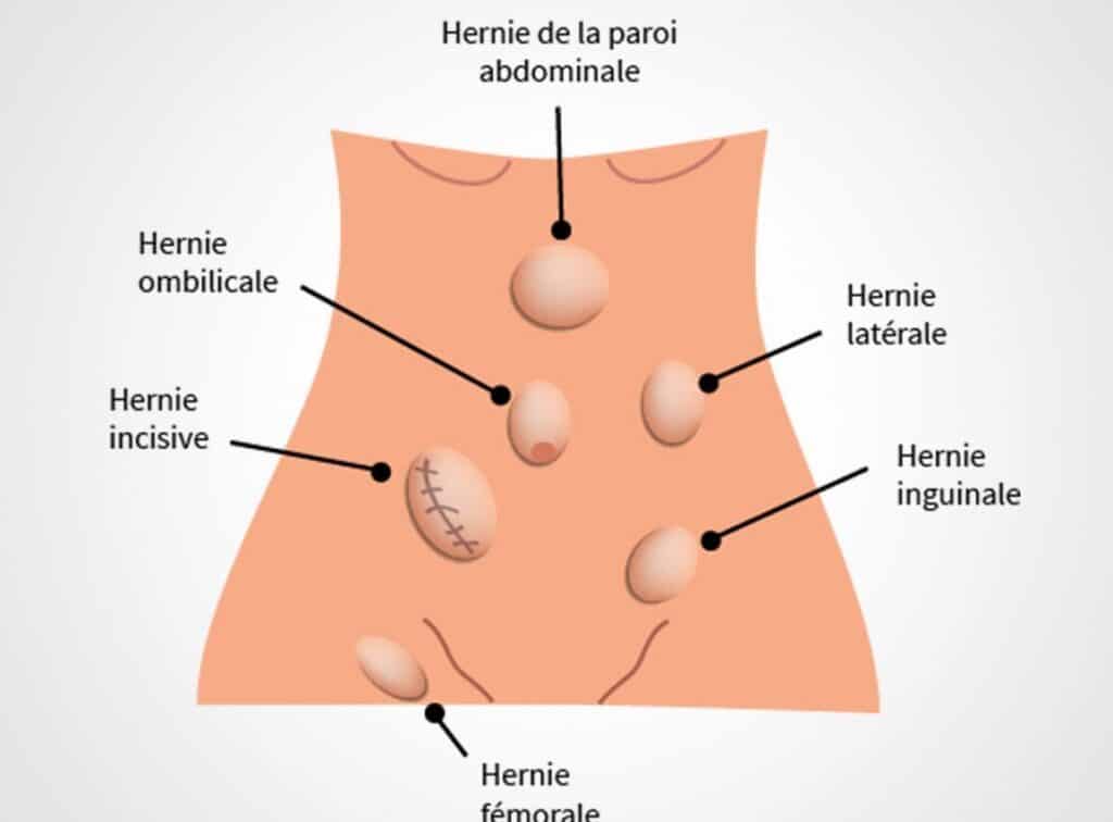 Comment reconnaître et traiter les hernies de la paroi abdominale ?