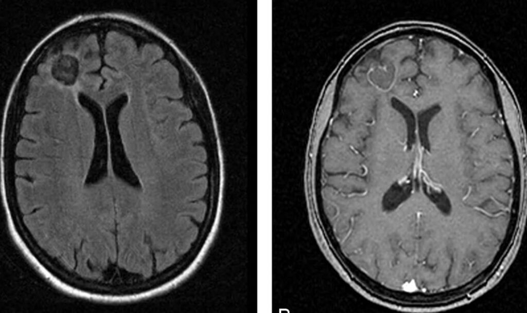 Comprendre la cavité porencéphalique : causes, symptômes et traitements