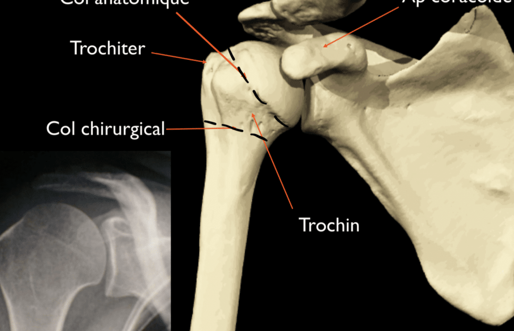 Dysplasie fibromusculaire : quelle incidence sur l&rsquo;espérance de vie ?