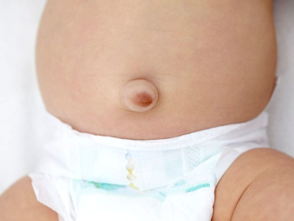 Hernie ombilicale chez l’enfant : comment la reconnaître et quand consulter ?