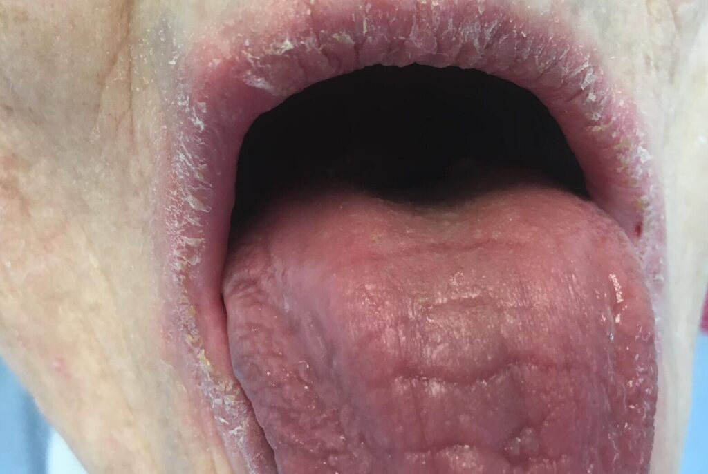 Qu’est-ce que le syndrome de Gougerot-Sjögren ?