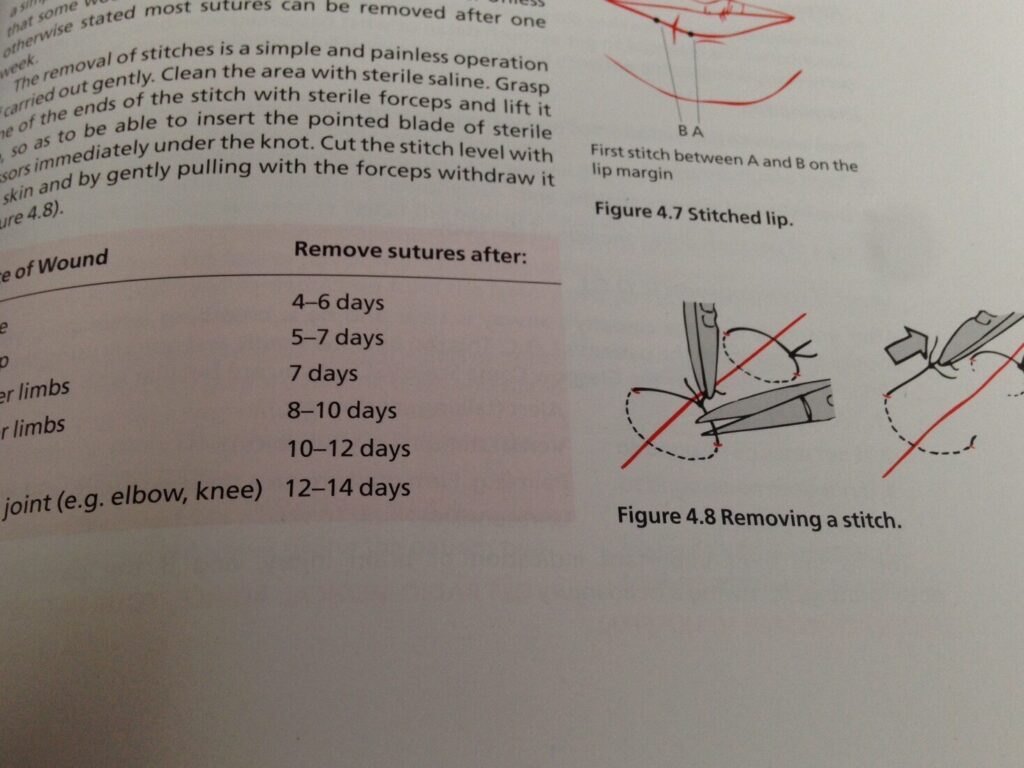 Savoir quand retirer les sutures du crâne: conseils et recommandations