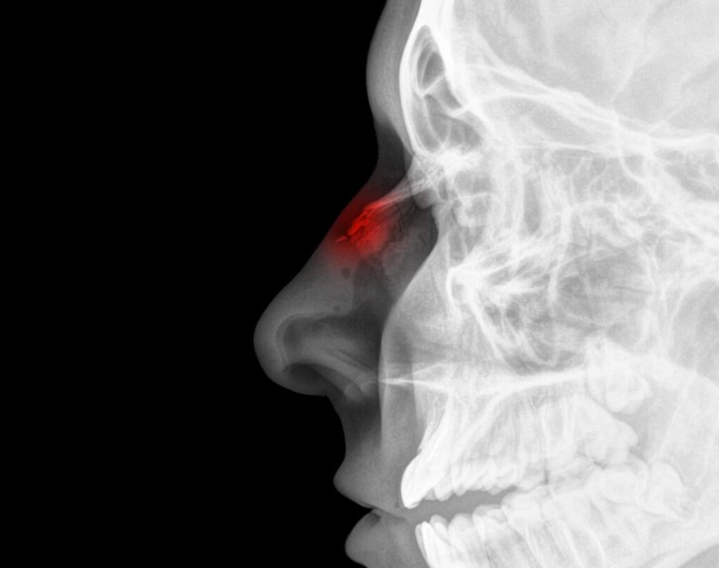 Comment reconnaitre et traiter une fracture des os propres du nez ?