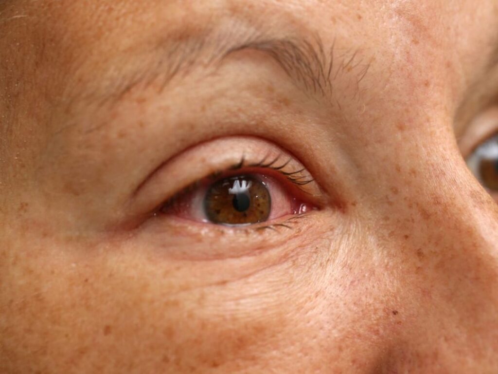 Comment soulager rapidement les allergies oculaires au quotidien ?