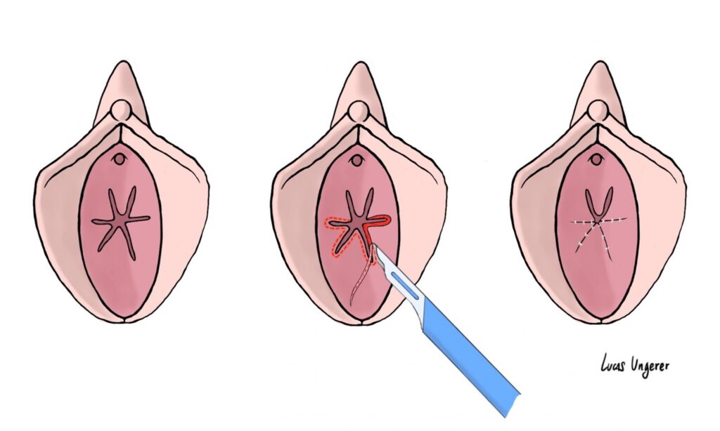 Comprendre l&rsquo;imperforation hyménéale : causes, symptômes et traitements