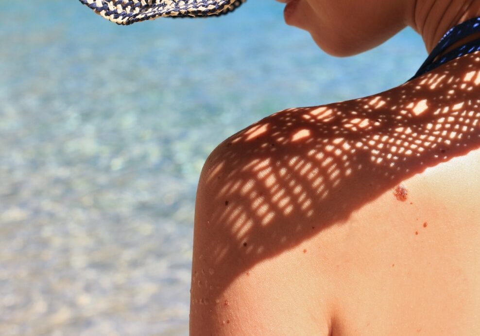 Les grains de beauté en abondance sont-ils un signe de danger pour la santé ?