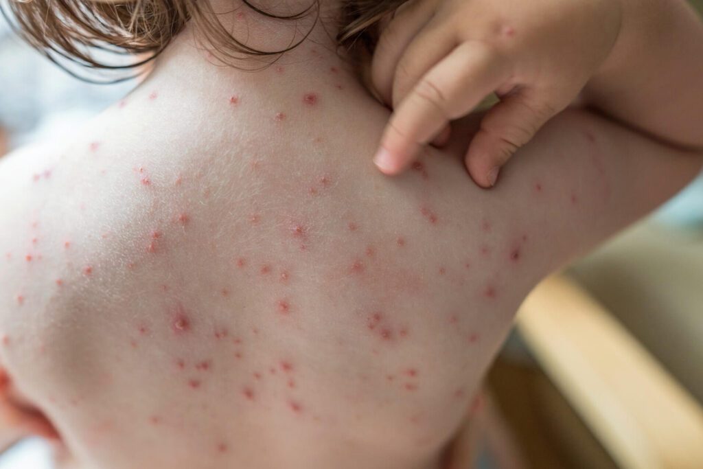 Comment identifier et traiter une photo de bouton de varicelle infecté ?
