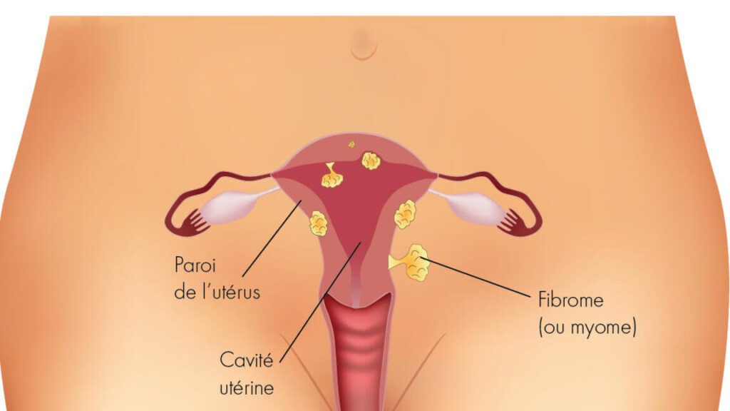 Comment reconnaître un fibrome utérin : symptômes, traitements et photos explicatives