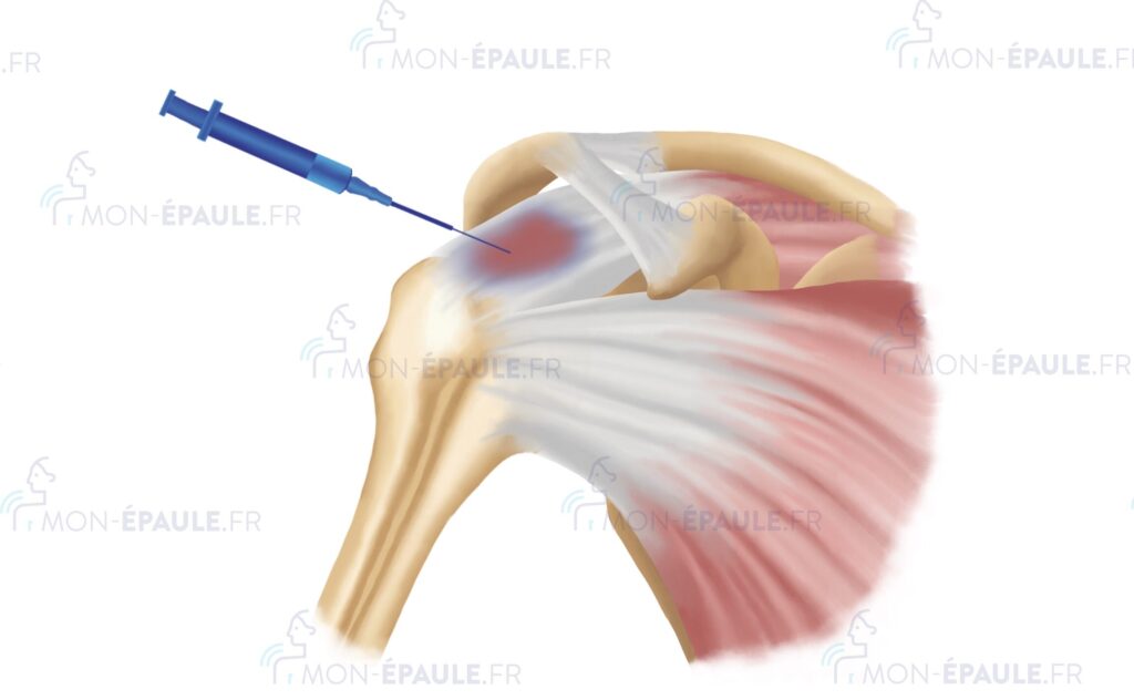 Comment soigner une fracture de l’humérus efficacement ?