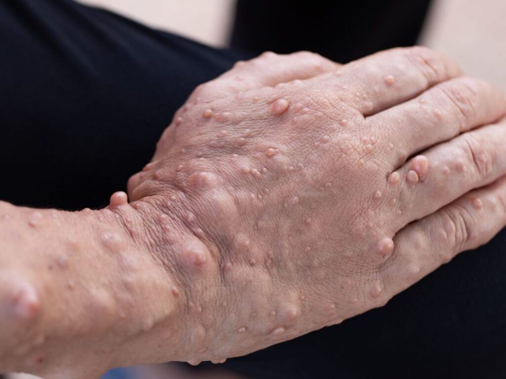 Comprendre les nodules de Lisch : symptômes, causes et traitements