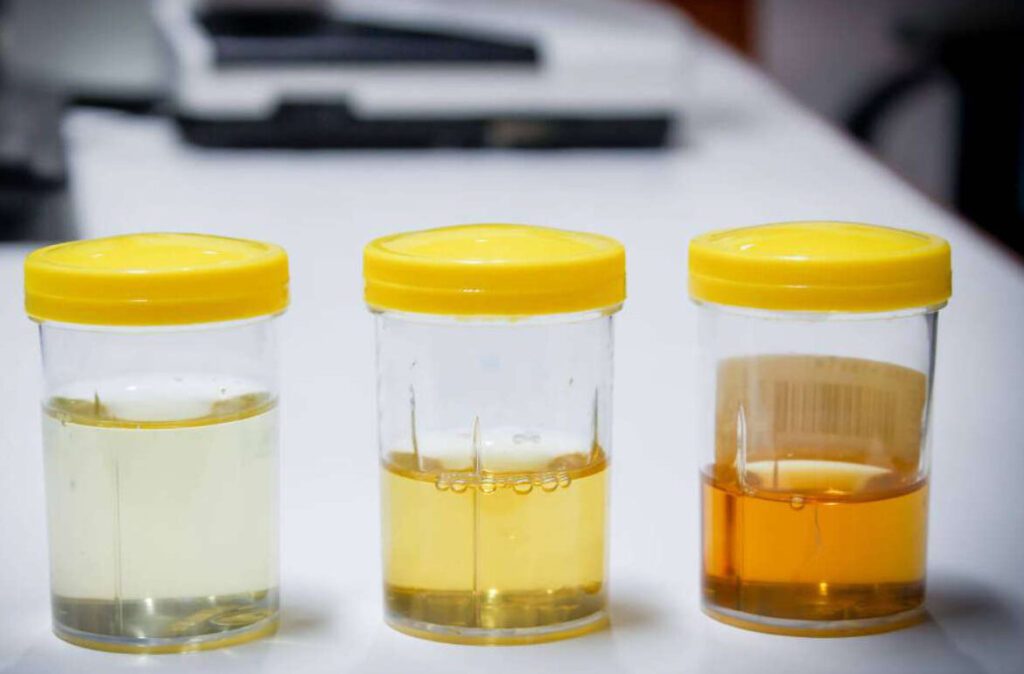 Pourquoi trouve-t-on parfois une urine huileuse ? Causes et conseils