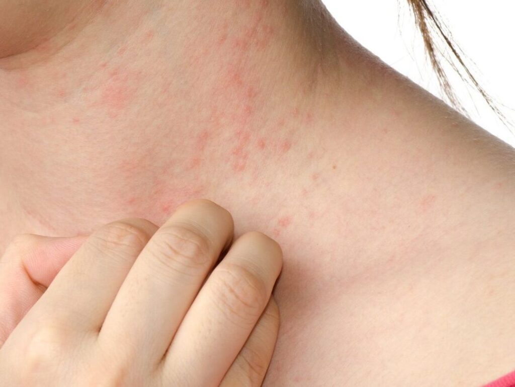 Xérose cutanée : comment reconnaître et soigner la peau sèche ?