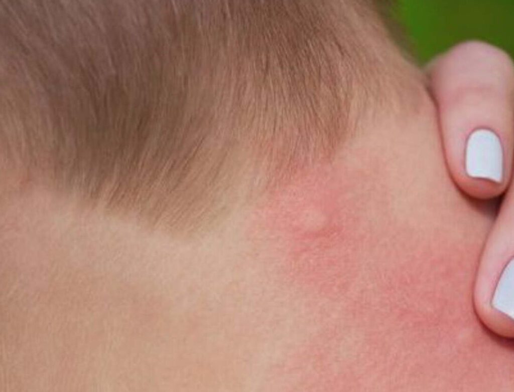 Piqûres d’acariens : comment les identifier et les traiter ?