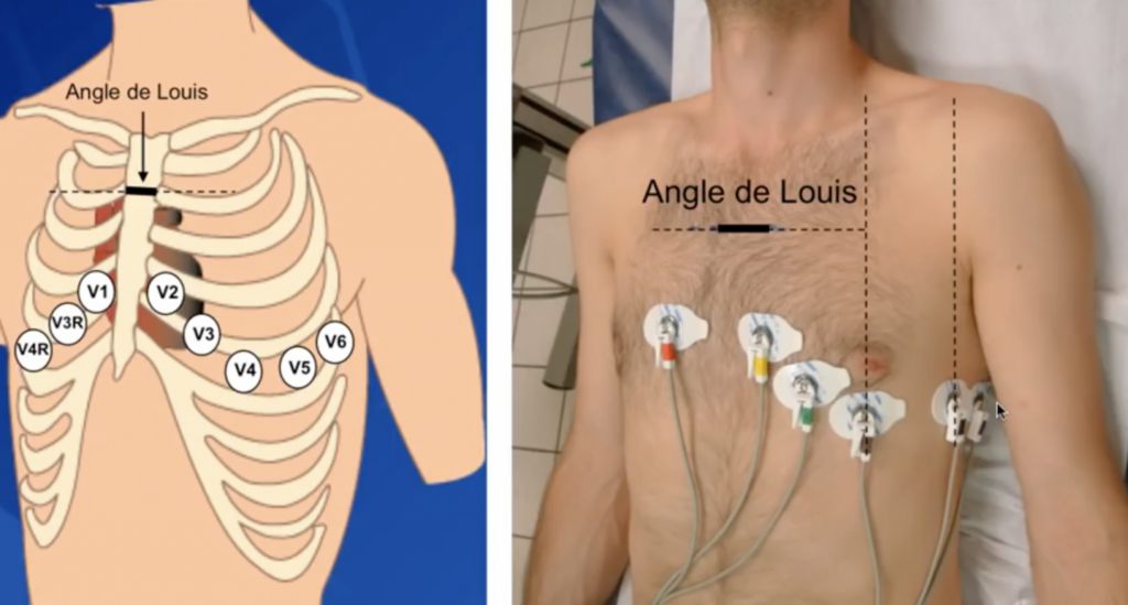 Comment interpréter un ECG en cas de fibrillation auriculaire ?