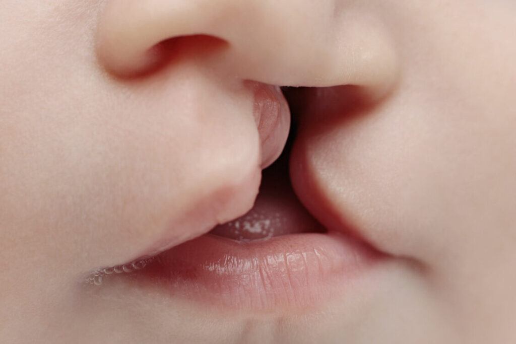 Comment vivre avec un bec de lièvre à l’âge adulte ?