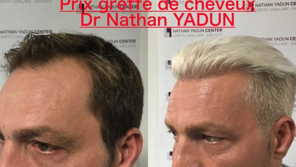 Quel est le prix d’un implant capillaire en Turquie ?