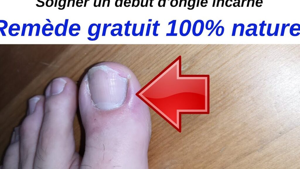 Comment enlever un ongle incarné sans douleur ?