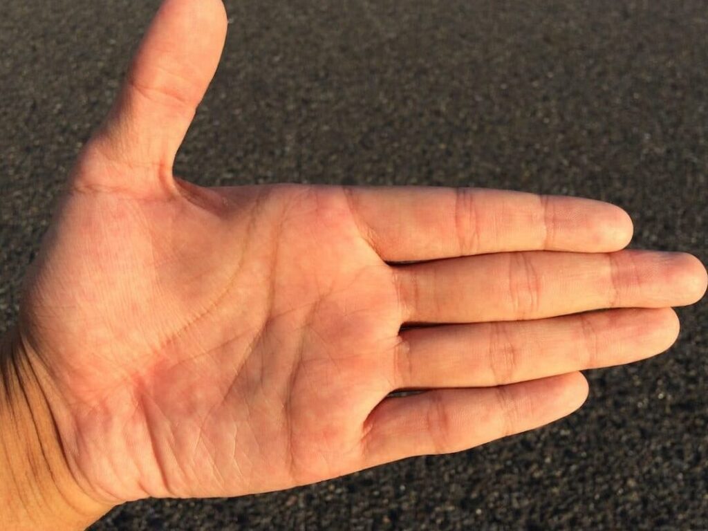 Comment savoir si vous avez cassé votre petit doigt ?