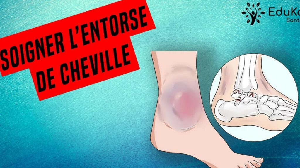 Comment soigner rapidement une cheville tordue ?