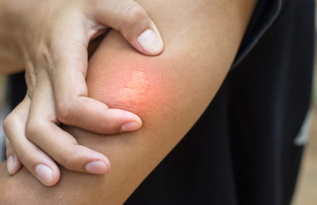 Comment traiter une piqûre d’abeille et quand consulter un médecin ?