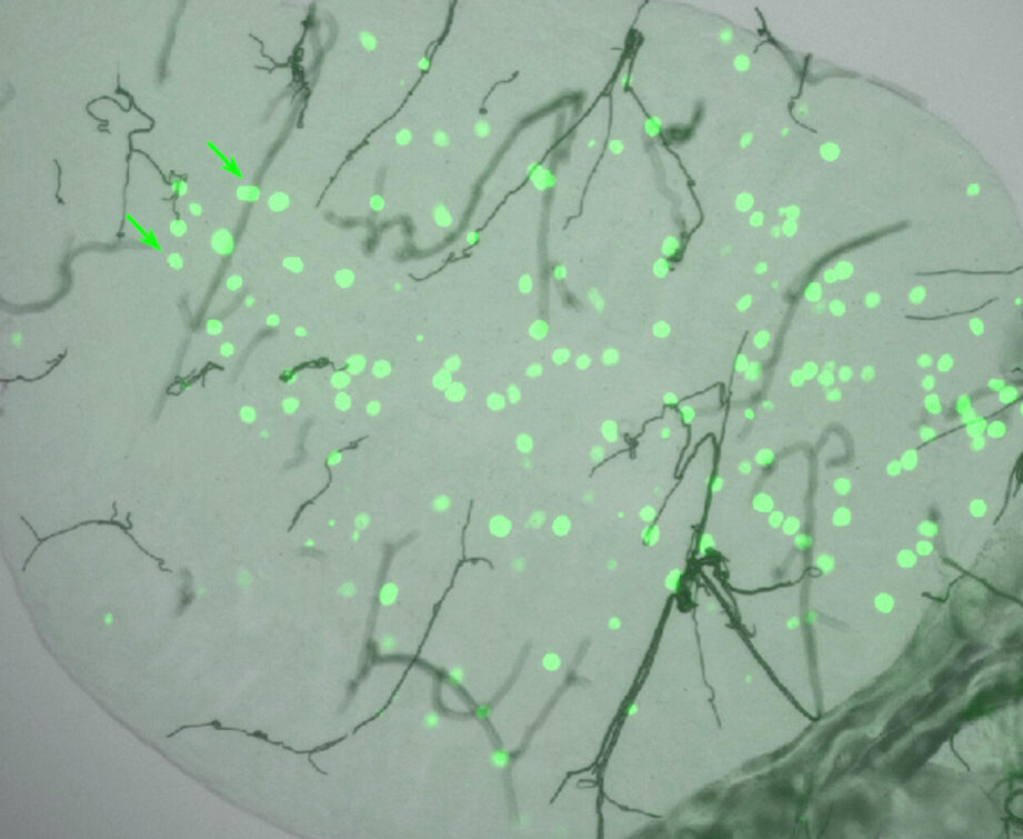 Corps d’Auer : indicateur clé dans le diagnostic de la leucémie aiguë myéloblastique