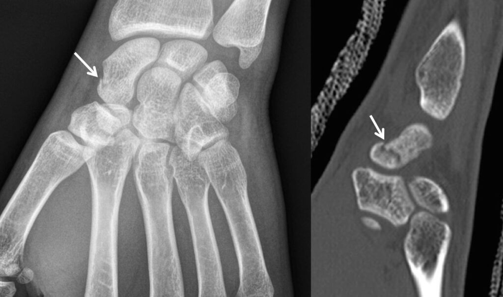 Douleur au poignet : pourrait-il s’agir d’une fracture du scaphoïde ?