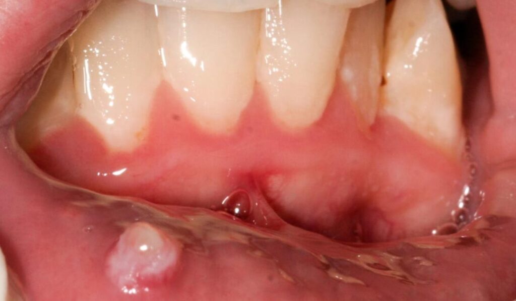 Mucocele de la lèvre : causes, symptômes et traitements efficaces