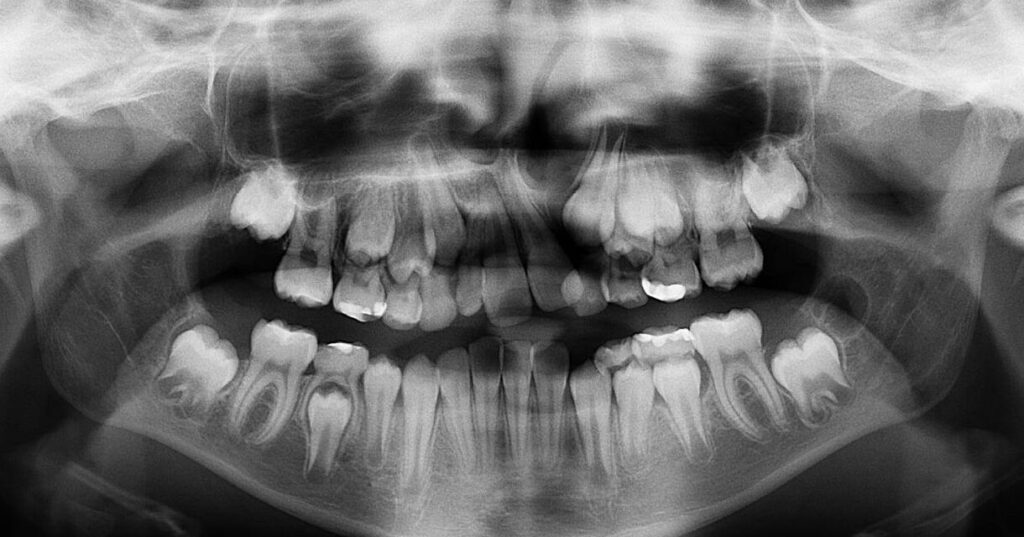 Fracture maxillo-zygomatique : de quoi s’agit-il exactement ?