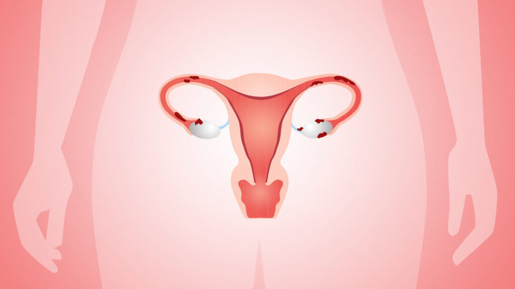 Morceau d’endomètre dans les règles : que signifie ce phénomène ?
