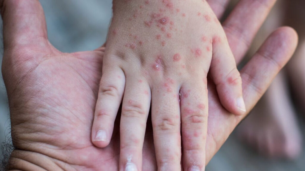 Quelles maladies peuvent causer des photos de cloques sur la peau ?