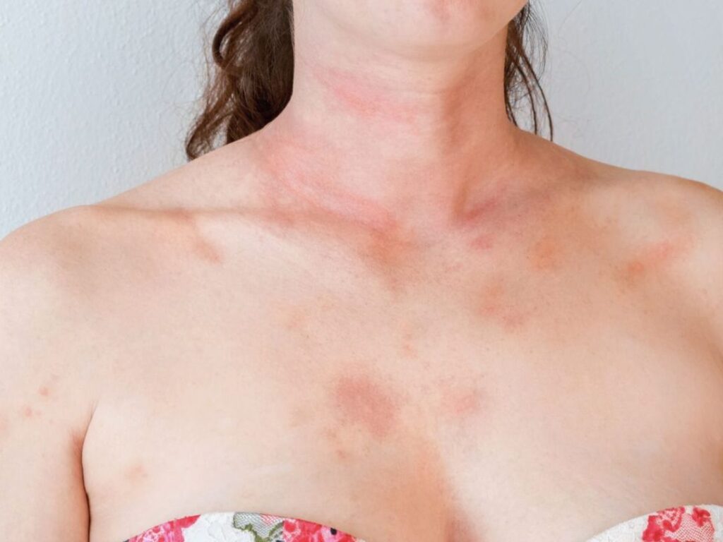 Allergie au soleil : comment reconnaître une photodermatose ?
