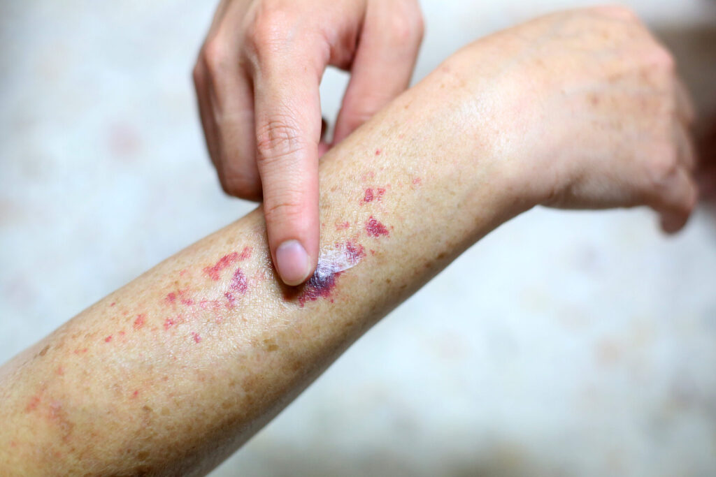 Comprendre le purpura de Bateman : symptômes, causes et traitements