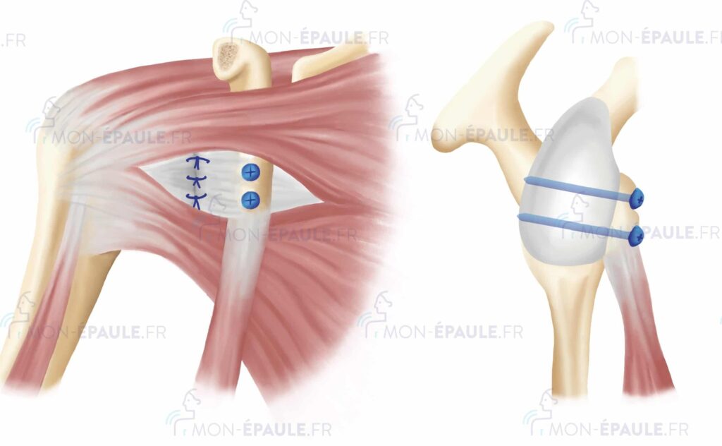 Que signifie l’encoche de Malgaigne en anatomie humaine ?