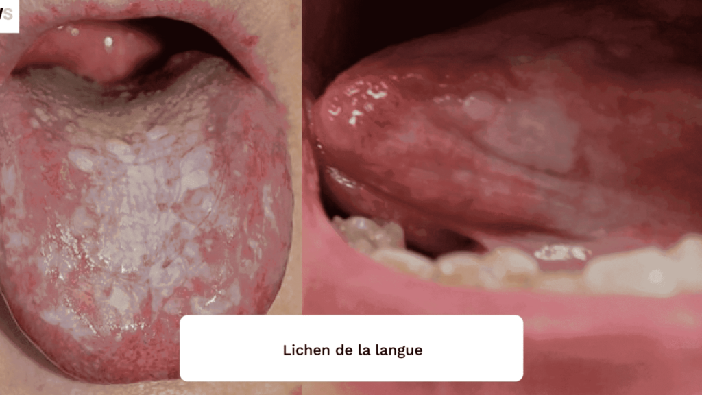 reconnaître et traiter le lichen plan en images