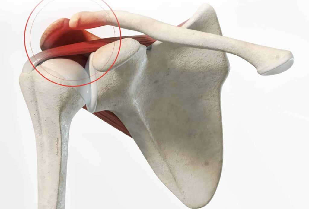 Comment gérer une luxation acromio-claviculaire au quotidien ?