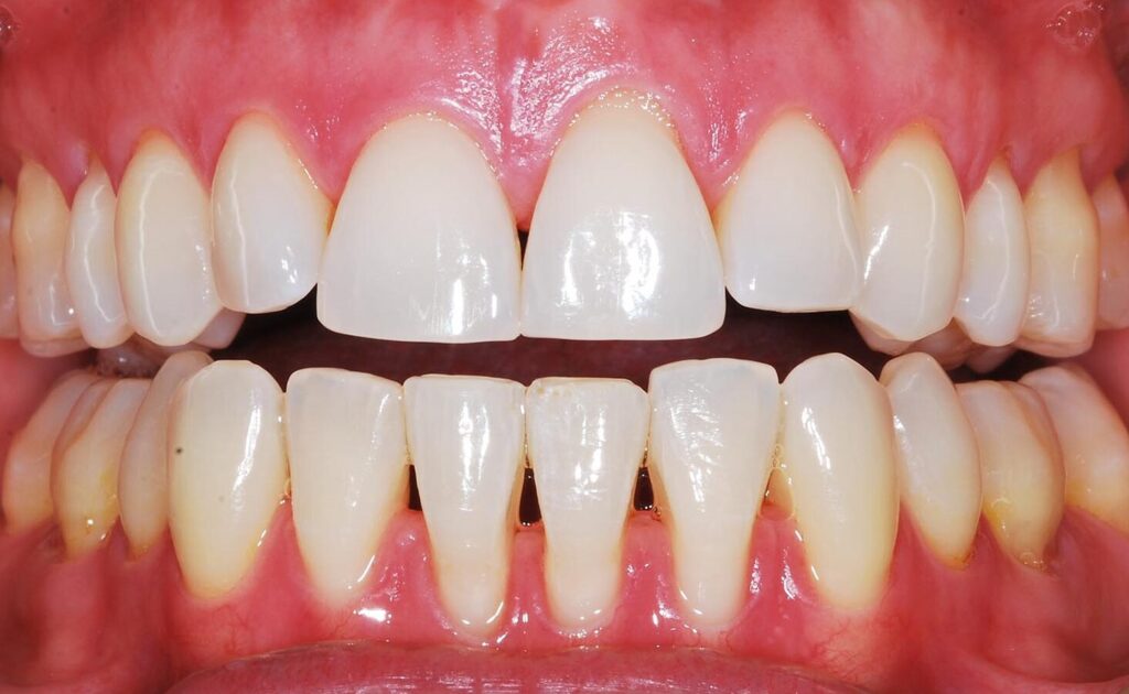 Comment traiter la récession gingivale sans chirurgie ?