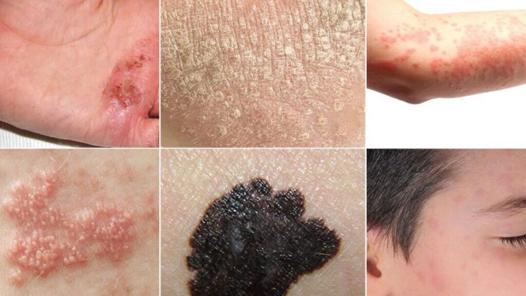 Lesion dermatologique : comment reconnaître et traiter les différentes affections de la peau ?