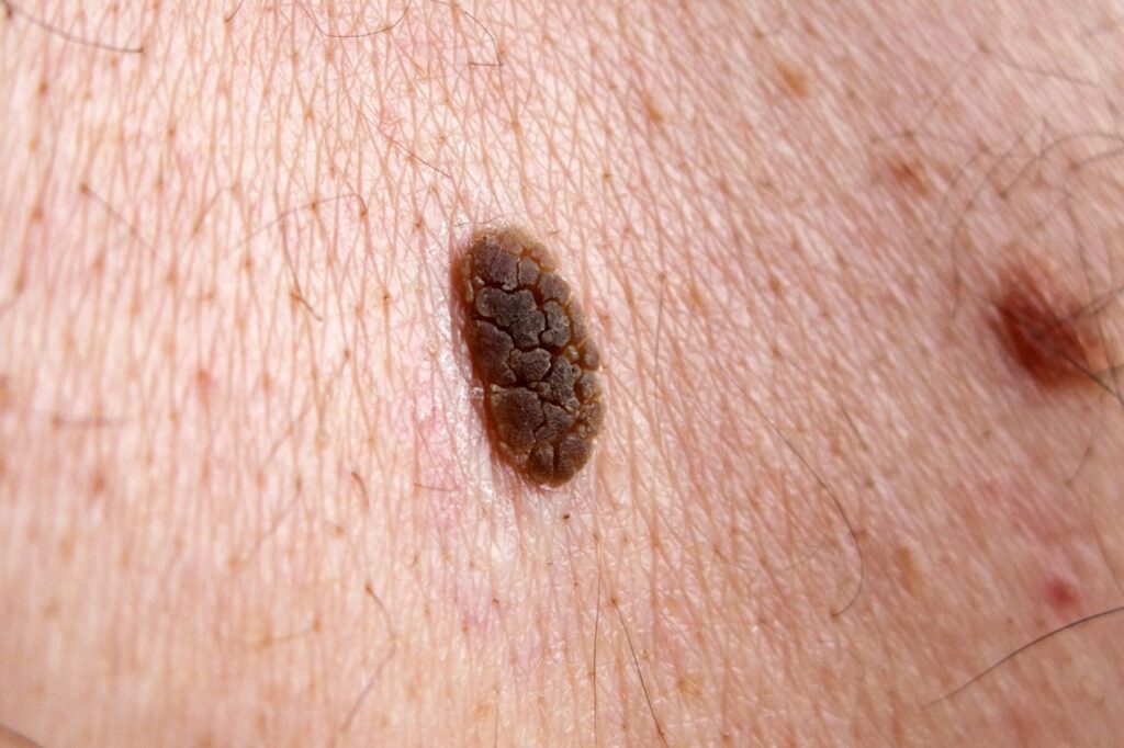 Qu’est-ce que la kératose séborrhéique ? Symptômes, causes et traitements illustrés en photos