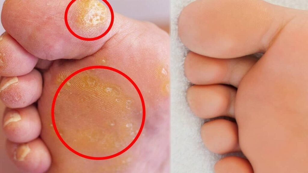 Comment traiter efficacement un cal au pied ?