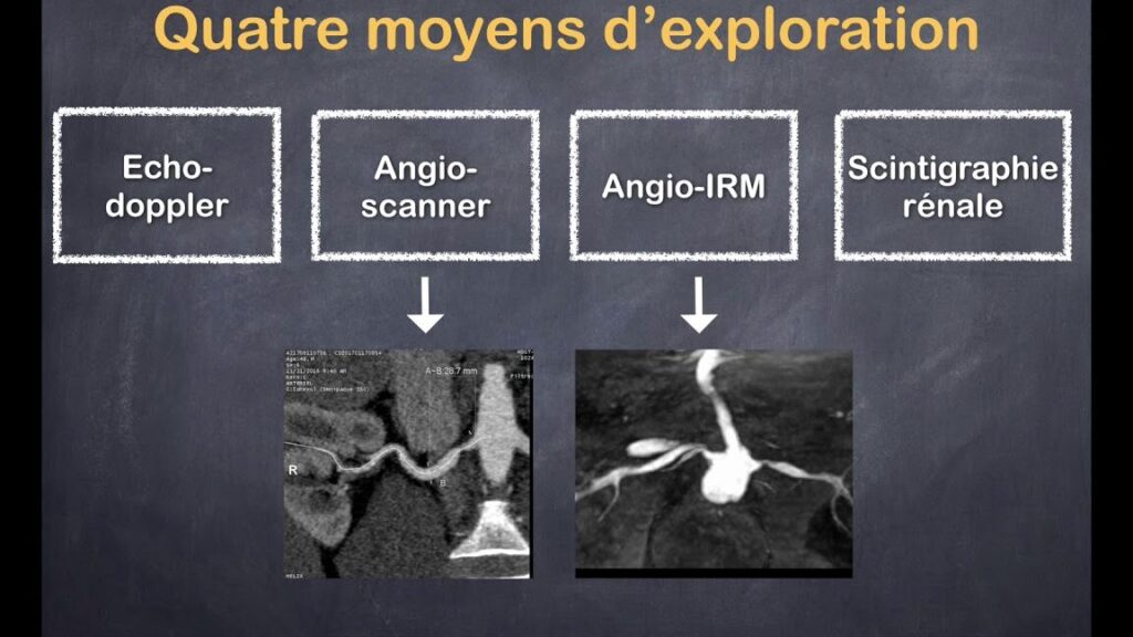 Comprendre la sténose de l’artère rénale : causes, symptômes et traitements