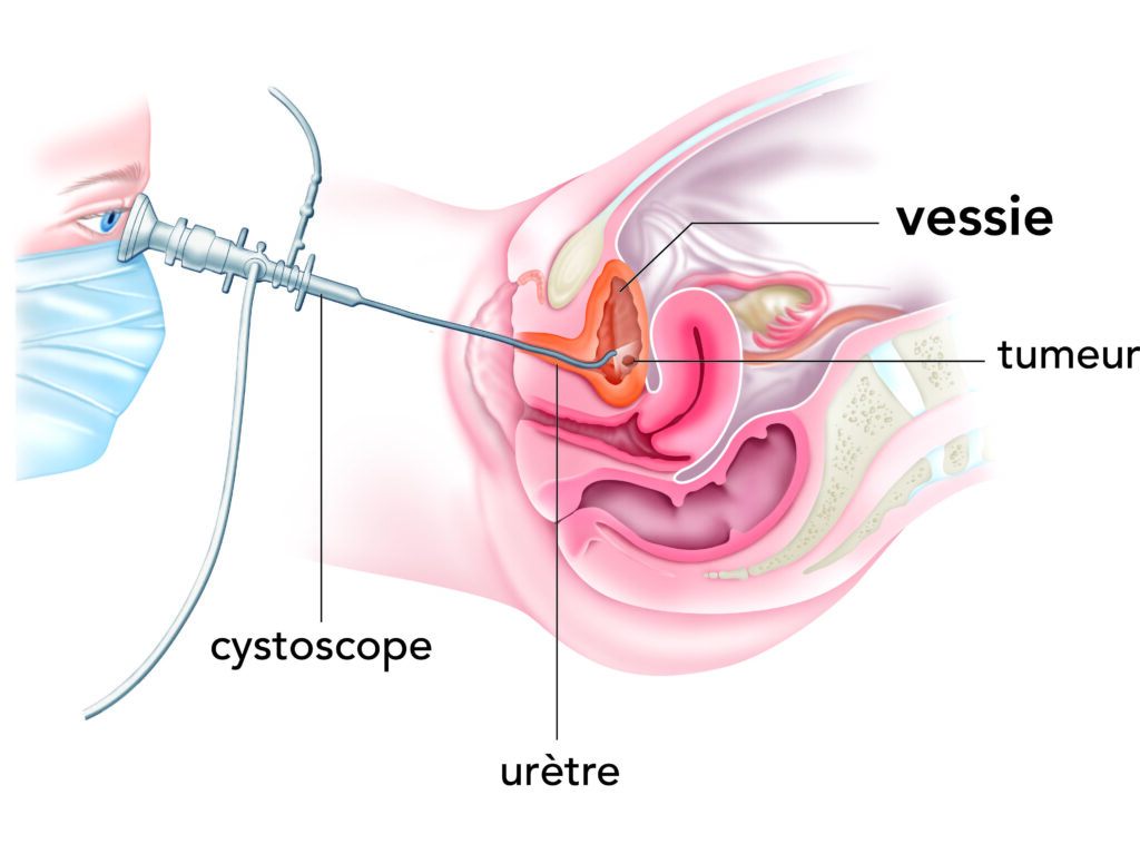 Comprendre la vessie neurologique : quels sont les symptômes à surveiller ?