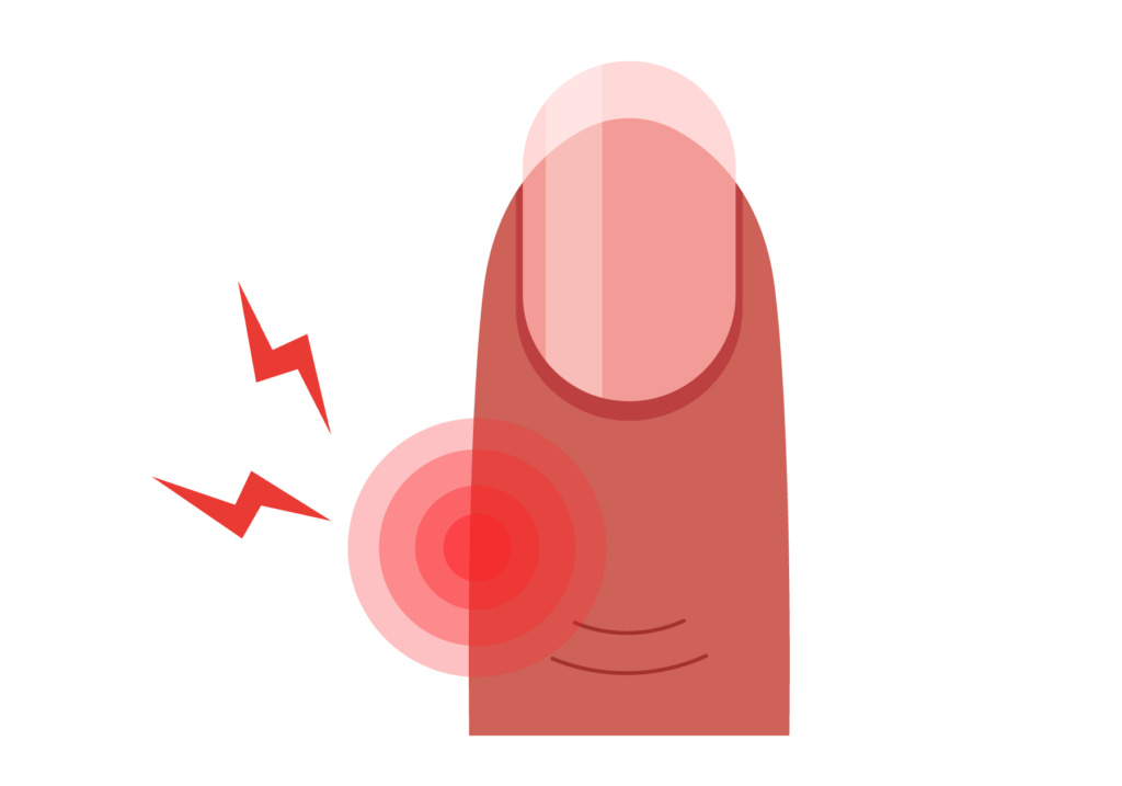 Doigt gonflé et mallet finger : comment reconnaître et traiter cette blessure ?