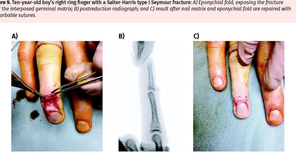 Fracture de Salter : comment identifier et traiter les blessures de croissance chez les enfants ?
