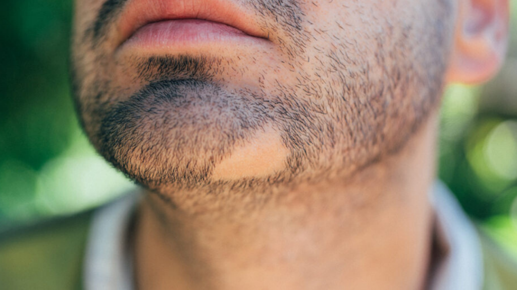 Pelade de la barbe : quel traitement choisir ?