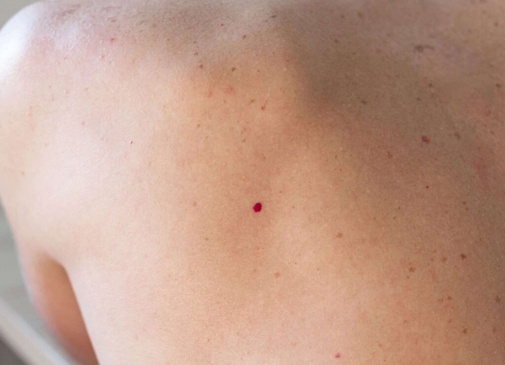 Comment reconnaître et traiter les angiofibromes cutanés ?