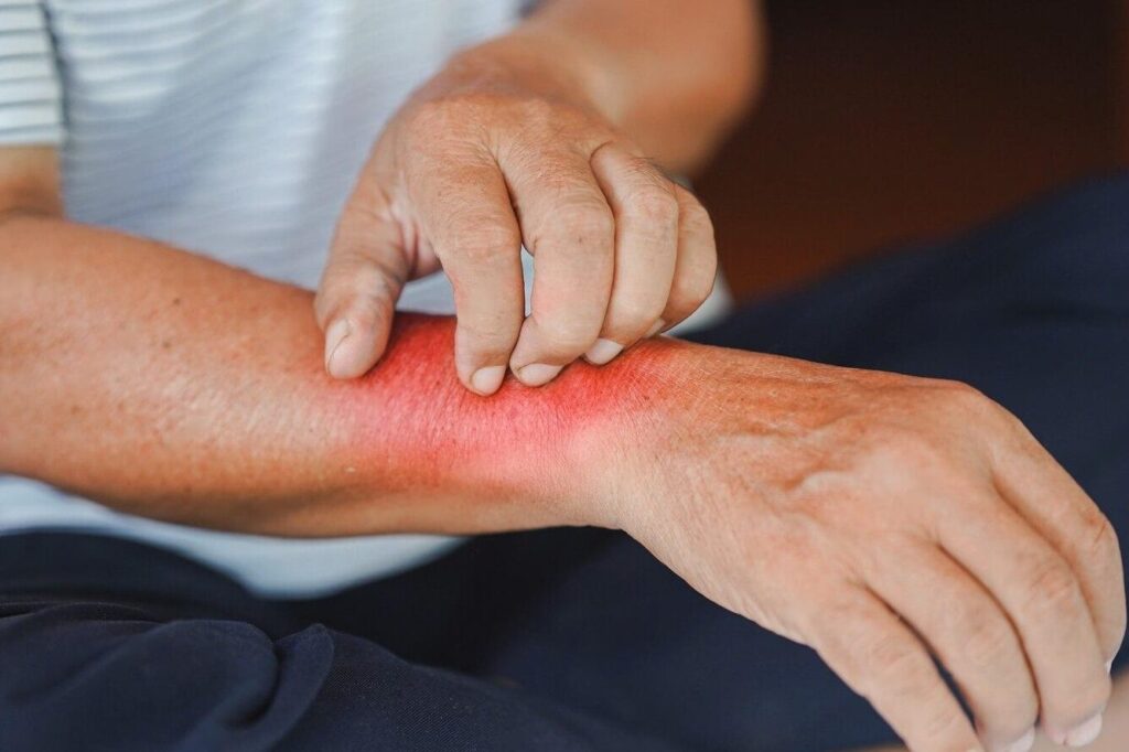 Comment traiter une brûlure chimique sur la peau ?