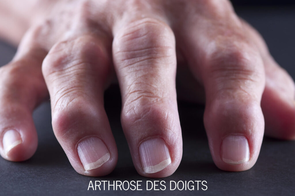 Comprendre les nodules d’Heberden : origines, symptômes et traitements