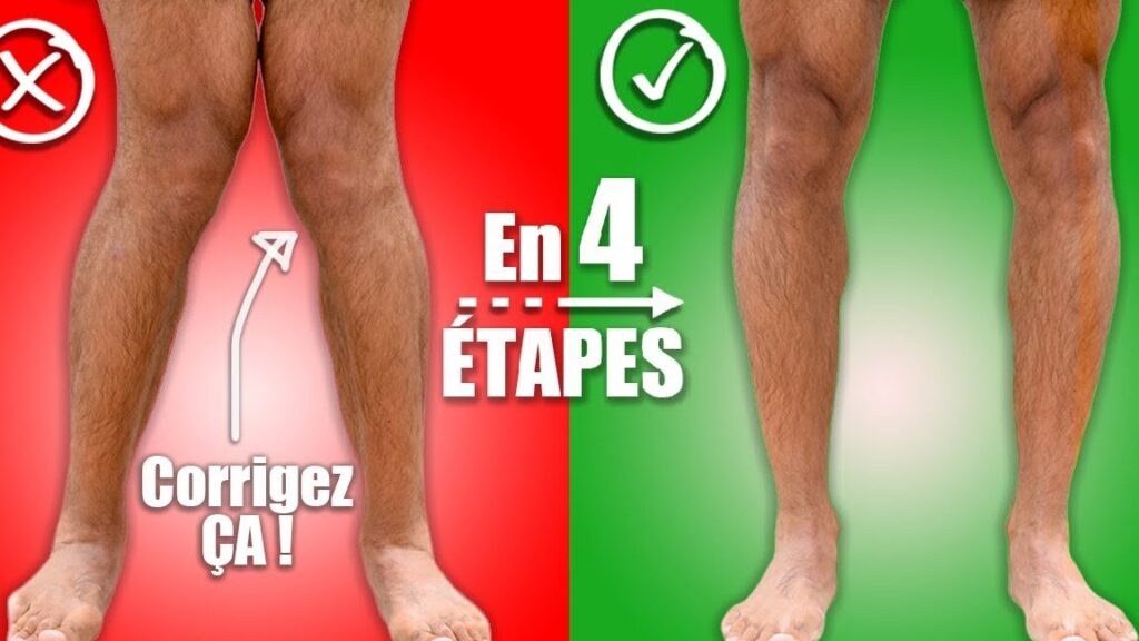 Comment corriger les genoux arqués chez les adultes ?