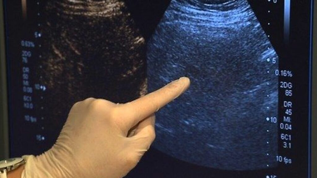 Échographie hépatique : à quoi s’attendre durant cet examen du foie ?