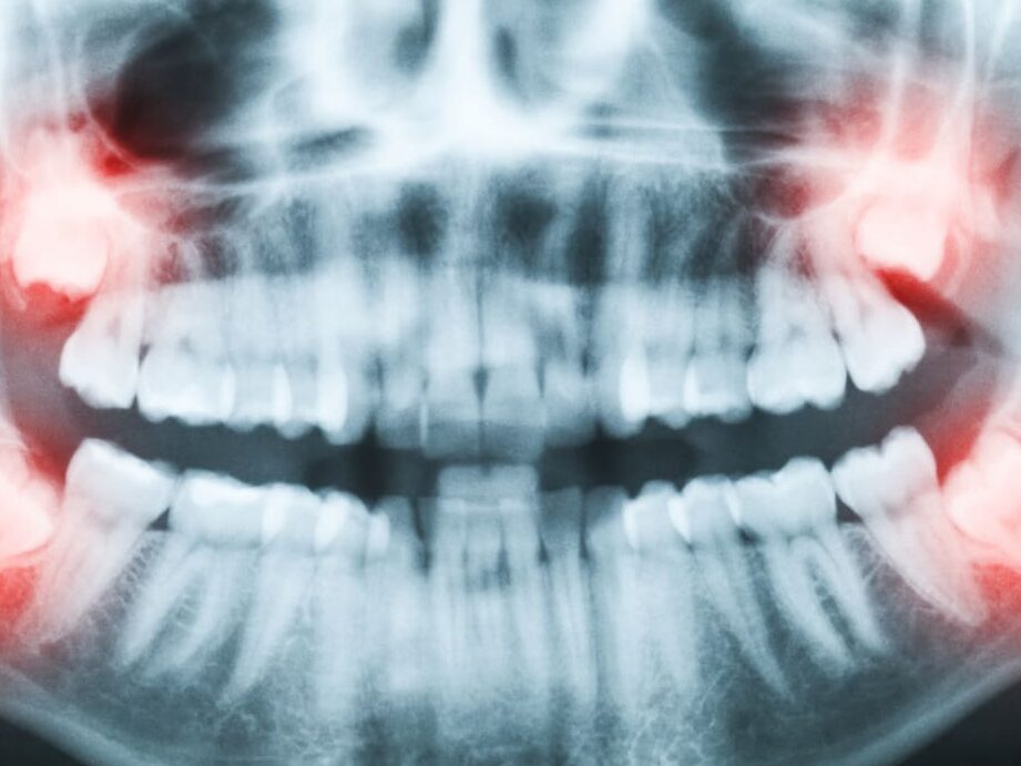 Ostéonécrose de la mandibule : comment la reconnaître et la traiter ?